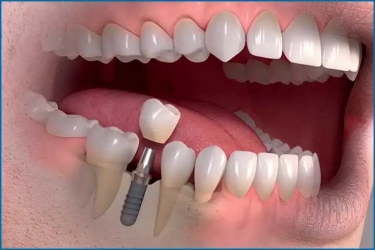 Poza Cum sa alegi implantul dentar perfect adaptat starii tale de sanatate orala, intr-o lume plina de oferte comerciale